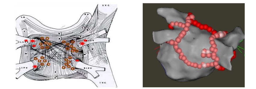  A) Rappresentazione dell’atrio sinistro: area estesa della parete posteriore con con cortocicuiti che sostengono la fibrillazione atriale.
B) Viengono eseguite lesioni lineari che isolano elettricamente anche l’area di parete atriale alterata.