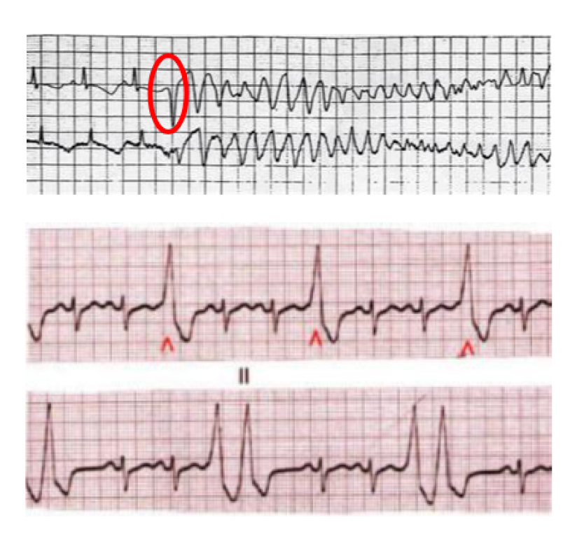 Fig 5: extrasistole ventricolare in presenza di una malattia dei canali ionici
(QT lungo) che provoca una aritmia ventricolare prolungata che provoca arresto cardiaco.