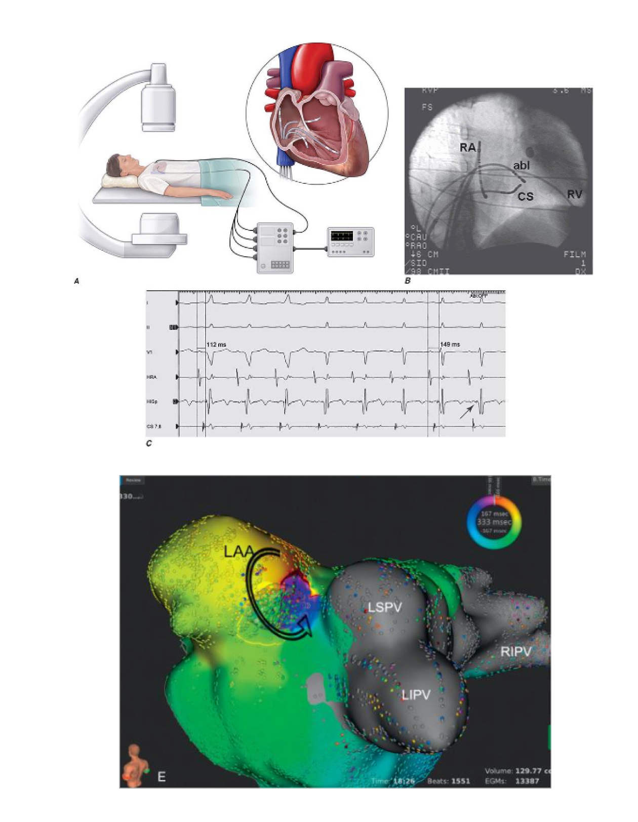 Fig 1 
A: Posizionamento degli elettrodi nelle cavità cardiache inserendoli in sede inguinale 
B: Posizionamento degli elettrodi nelle cavità cardiache immagine radiologica
C: Segnali elettrici registrati mediante gli elettrodi intracardiaci in corso di una aritmia 
D: Mappa elettroanatomica: si visualizza la camera cardiaca ove ha origine la aritmia .I diversi colori indicano il percorso della aritmia